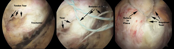 Trochanteric Bursitis  Hip Bursitis Treatment Sydney
