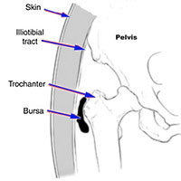 Hip Bursitis - Treatment in Burlington ON